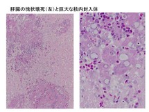 肝臓の塊状壊死と巨大な封入体