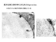 巨大な封入体の中に見られたpapovavirus