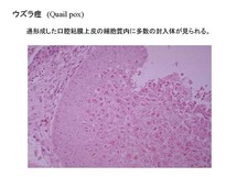 ウズラ痘