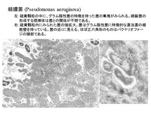 Pseudomonas aeruginosa