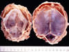 頭蓋異常(小脳頭蓋形成不全と大脳頭蓋の腫大)