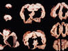 脳、横断面、脳室の拡張と大脳皮質の非薄化