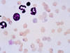 血液塗沫像、赤血球に多数のエペリスロゾーンが寄生 