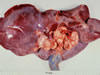 肝臓と肝リンパ節の腫大