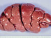 腎の結節状腫瘍化病巣