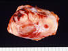 リンパ節の腫瘍