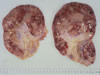 乳房リンパ節腫瘍化病巣(割面)