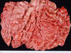 四胃粘膜の腫瘍性肥厚