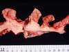 四胃粘膜の腫瘍性肥厚(割面) 