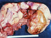 子宮の腫瘍化病巣