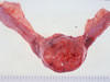 空腸の腫瘍化病巣