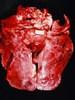 肺の肝変化巣。