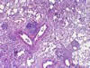 気管支・細気管支周囲のリンパ球浸潤を特徴とする肺炎、HE染色。