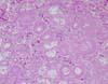 上の写真の拡大像。尿細管におけるアミロイド沈着が明かである。 HE染色、x00。