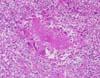 赤脾髄における多核巨細胞反応を伴ったアミロイド沈着。 HE染色、x400。