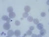 血液塗沫像、赤血球の塩基性斑点