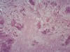 小脳髄質の壊死巣と肉芽腫巣、HE染色