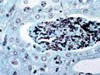 腎集合管内の菌糸、グロコット染色