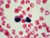 血液塗沫像、担鉄細胞の出現。