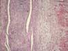 腱鞘滑膜炎、リンパ球タイプ。HE染色、x20。