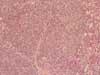 白脾髄における腫瘍性リンパ球増殖。