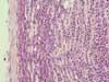 坐骨神経における腫瘍性リンパ球浸潤。HE染色、x100。