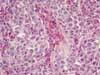 脾臓。均一なリンパ芽球性腫瘍細胞増殖。HE染色、x100。