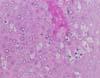 散在性の有棘細胞の変性 皮膚,HE染色