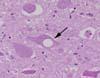  延髄(閂部)、迷走神経背側核。神経細胞の空胞化がみられる。 HE染色、x600。