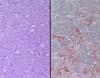 延髄(閂部)、三叉神経脊髄路核。 左:HE染色、x400。   三叉神経脊髄路核における神経網(ニューロピル)の空胞化。 右:免疫染色、x400。   空胞化病変部における異常プリオン蛋白質の沈着(赤茶色に染まっている)。