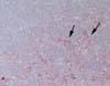 延髄(閂部)、三叉神経脊髄路核。空胞化病変部に異常プリオン蛋白質の沈着(赤茶色に染まっている)がみられる。 免疫染色、x400。