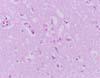 大脳皮質神経細胞における好酸性封入体の形成