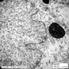 核内のウイルス粒子 皮膚有棘細胞,透過型電子顕微鏡像