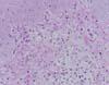 真皮表層の水腫と炎症性細胞浸潤丘疹部皮膚、HE染色、x400