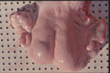 妊娠33日の双子妊娠子宮
