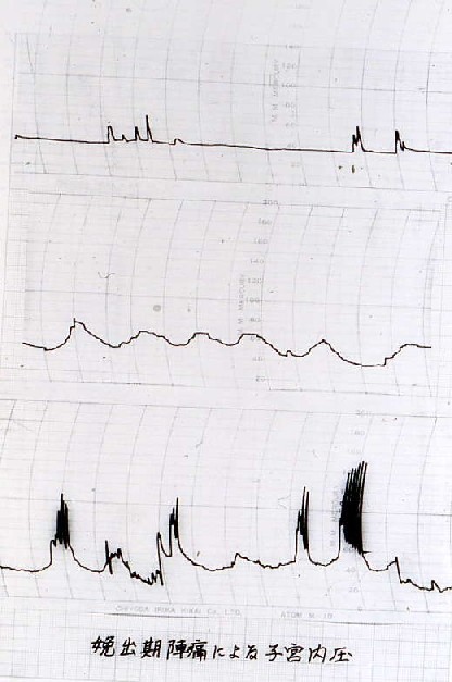 陣痛に伴う子宮内圧曲線