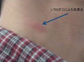 シラミダニによる皮膚炎