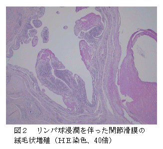図2 リンパ球浸潤を伴った関節滑膜の 絨毛状増殖