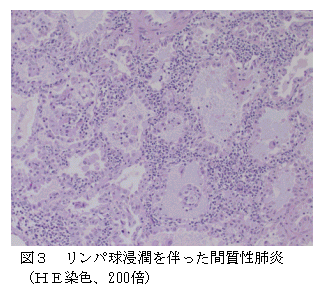 図3 リンパ球浸潤を伴った間質性肺炎