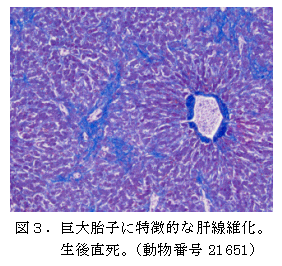 図3.巨大胎子に特徴的な肝線維化。 生後直死。