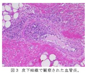 図3 皮下組織で観察された血管炎