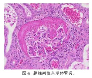 図4 線維素性糸球体腎炎