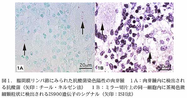 図1. 腸間膜リンパ節にみられた抗酸菌染色陽性の肉芽腫 1A:肉芽腫内に検出される抗酸菌