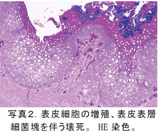 写真2.表皮細胞の増殖、表皮表層細菌塊を伴う壊死。 HE 染色。