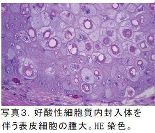 写真3.好酸性細胞質内封入体を伴う表皮細胞の腫大。HE 染色。