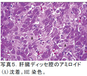 写真5.肝臓ディッセ腔のアミロイド(A)沈着。HE 染色。