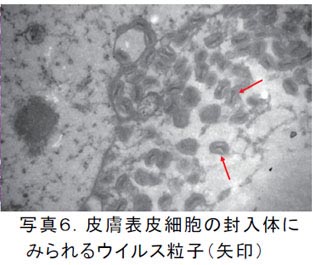 写真6.皮膚表皮細胞の封入体にみられるウイルス粒子(矢印)