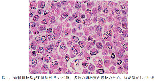 図1. 過剰顆粒型γδT 細胞性リンパ腫.多数の細胞質内顆粒のため、核が偏在している