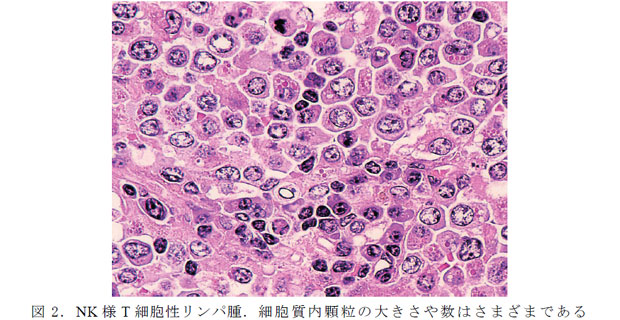 図2.NK 様T 細胞性リンパ腫.細胞質内顆粒の大きさや数はさまざまである