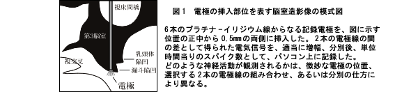 図1.電極の挿入部位を表す脳室造影像の模式図